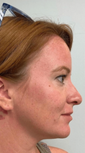 Before Image: Cheeks