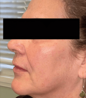 After Image: Cheeks - left-side