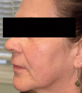 Before Image: Cheeks - left-side