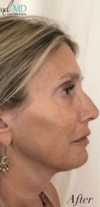 After Image: Cheeks and Lips