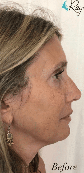 Before Image: Cheeks and Lips - right-side