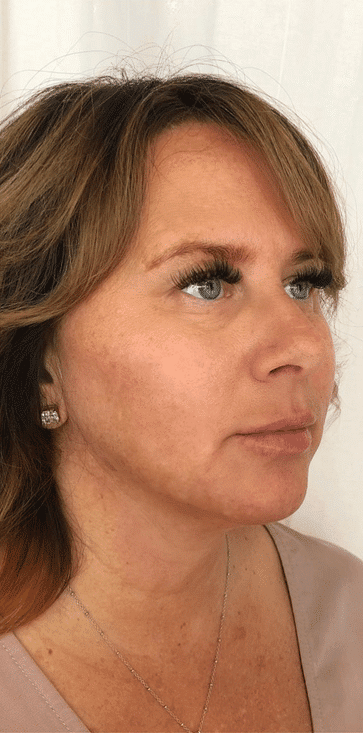 After Image: Cheeks - right-front-oblique