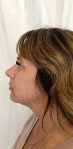 Before Image: Cheeks