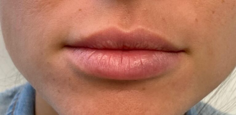Before Image: Lips - front