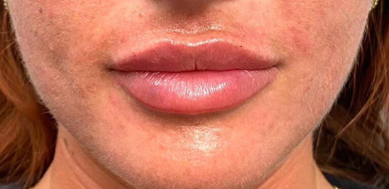 After Image: Lips - front