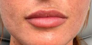 Before Image: Lips