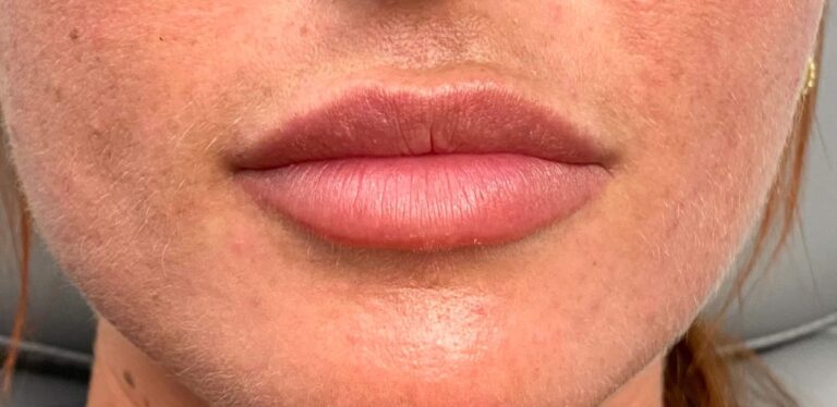 Before Image: Lips - front