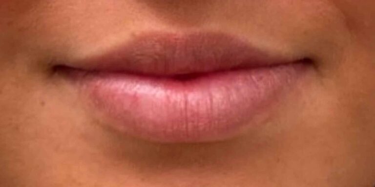 Before Image: Lips - front